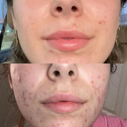 RedGlow | LED Licht Therapie Maske