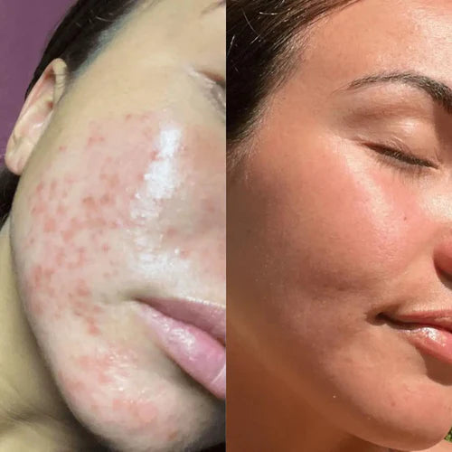 RedGlow | LED Licht Therapie Maske